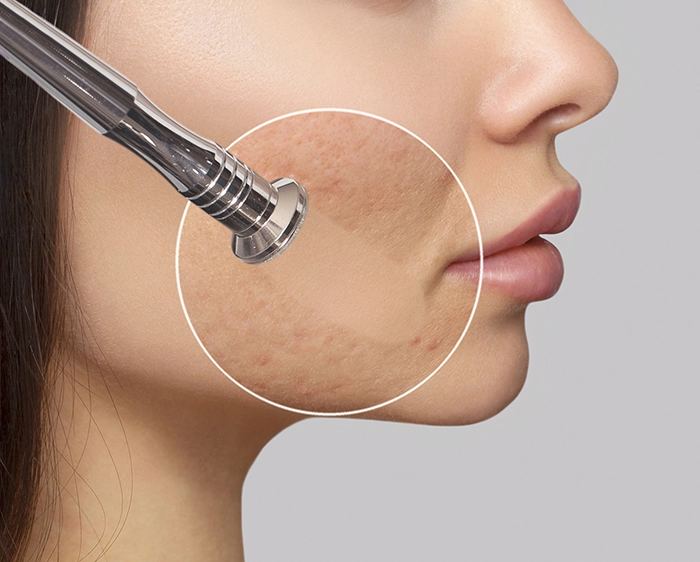 انجام میکرودرم ابریژن برروی قسمتی از صورت زنی که دارای اسکار و جوش است