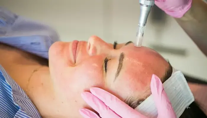 انجام میکرونیدلینگ بر روی صورت زن در کلینیک